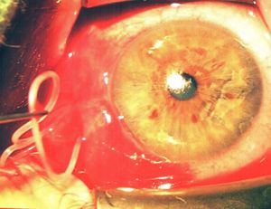 Kifejlett Dirofilaria féreg műtéti eltávolítása emberi szemből